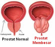 pembesaran kelenjar prostat